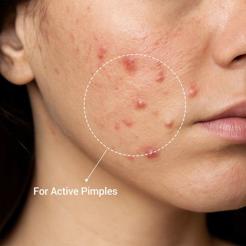 Acne Buster Plus Spot Gel