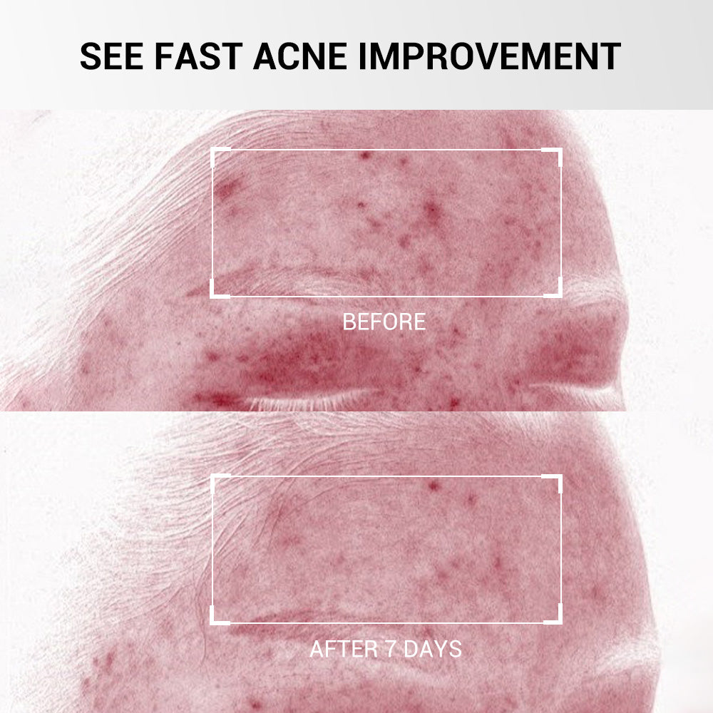 Acne Buster Plus Spot Gel